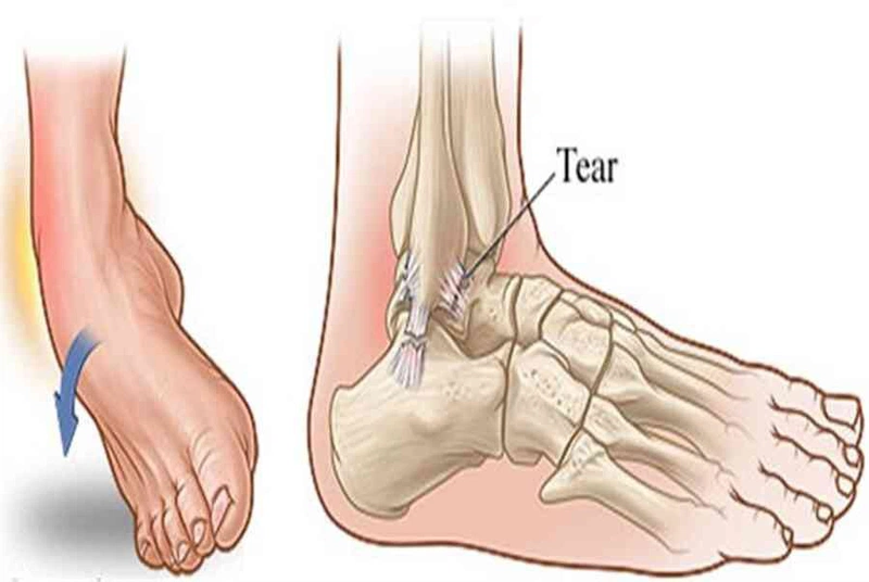 Xoay áo đến mắt cá chân là gì? Cách Điều Trị Trật Cổ Chân Ở Áo Sơ Mi An Toàn